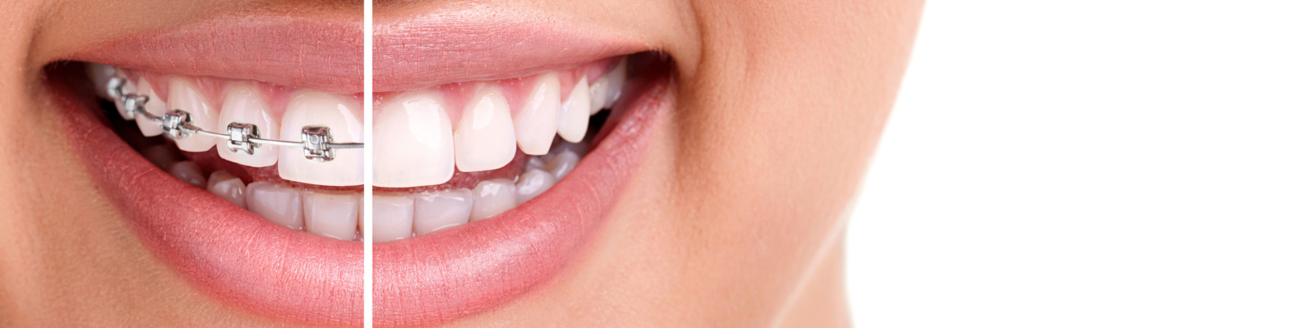 Woman's smile transformation with metal braces in Timnath CO