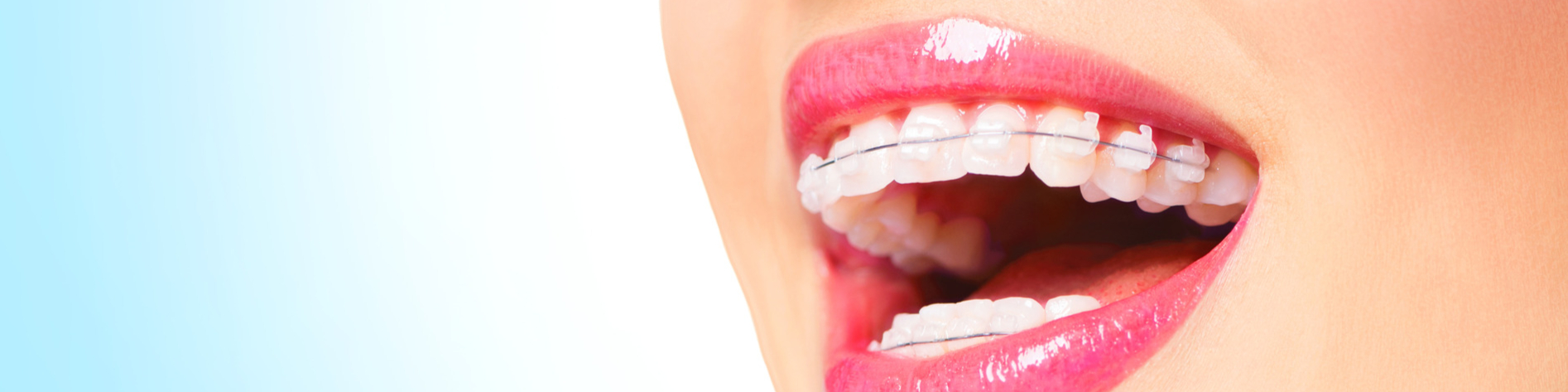 Woman with ceramic braces in Timnath CO