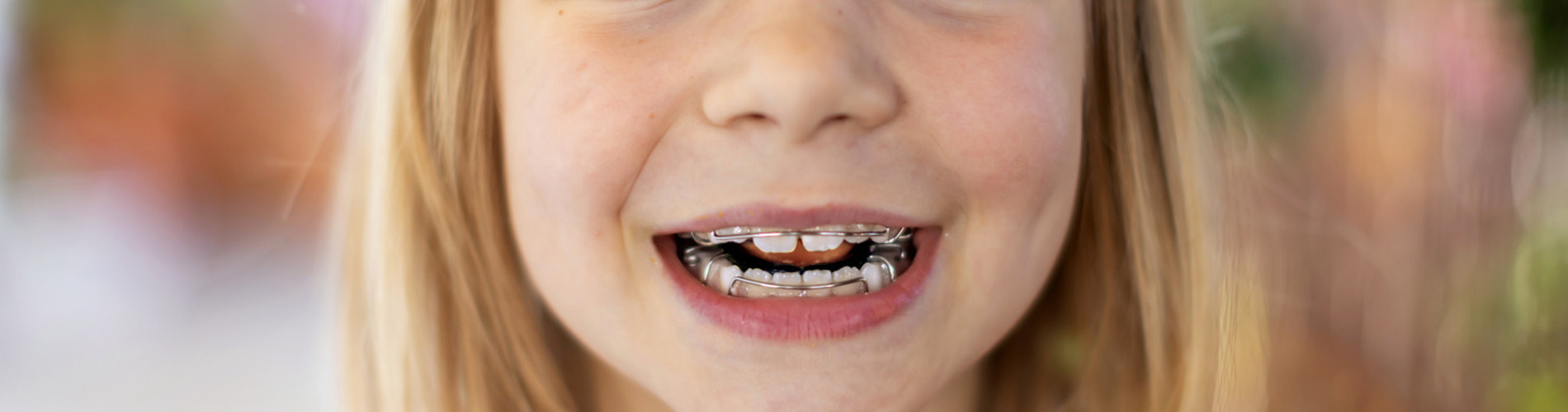 Child with space maintainers for early interceptive treatment at Black Diamond Orthodontics in Timnath CO