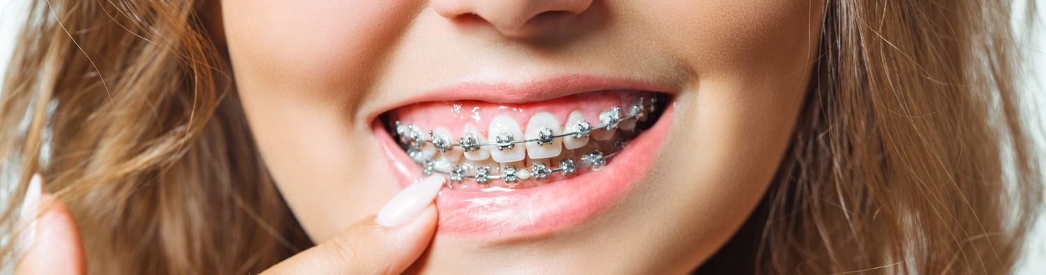 Adolescent iw braces in Timnath CO